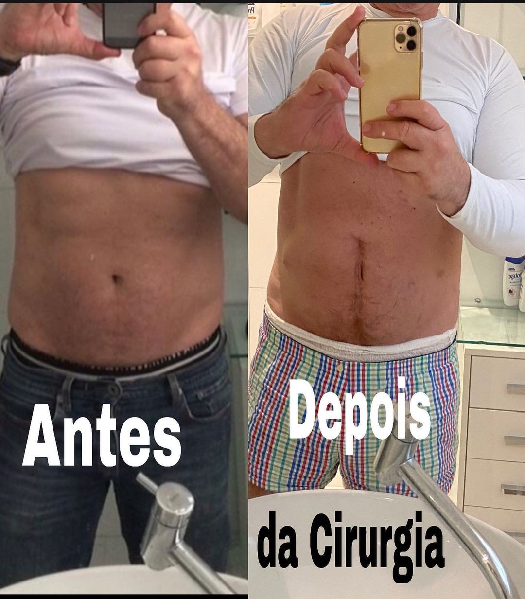 Beto Barbosa mostra cicatriz após cirurgia (Foto: Reprodução/Instagram)
