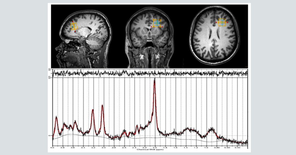 Depressão pós-parto afeta 19% das mulheres após o parto e cérebro sofre alteração (Foto: Reprodução)