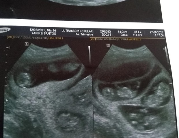 Yanike mostra ultrassom da gravidez de quintuplos (Foto: Arquivo pessoal)