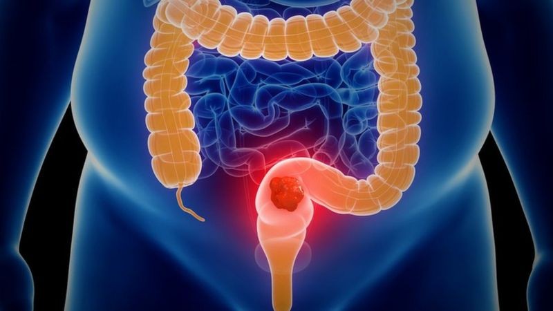 O câncer pode começar no cólon (intestino grosso) ou no reto (passagem posterior) e também é conhecido como câncer colorretal (Foto: Getty Images via BBC News)