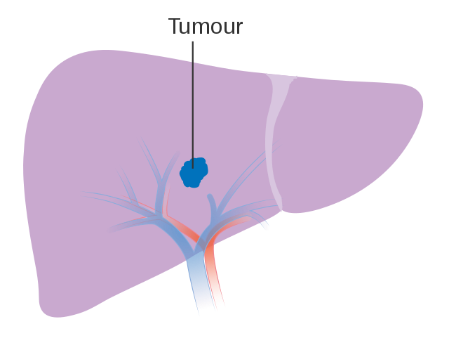 Pessoas que apresentam a doença hepática têm riscos maiores de desenvolverem câncer no orgão (Foto: Wikimedia Commons )