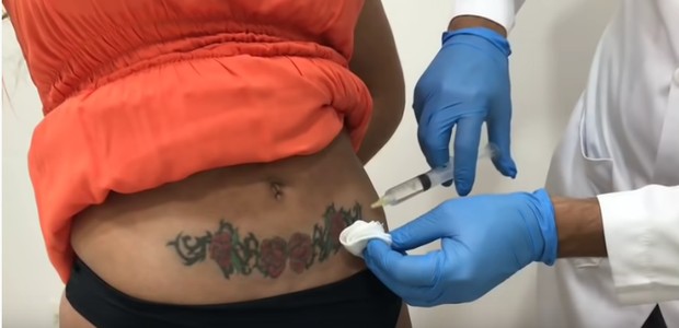 Andressa Urach remove tatuagens e cicatriz no bumbum (Foto: Reprodução/YouTube)