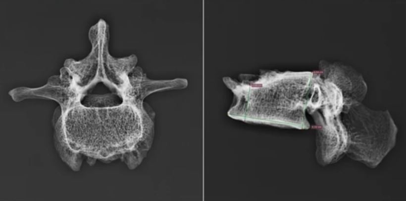 Radiografia digital da quarta vértebra lombar de pessoa morta em Pompeia (Foto: Gabriele Scorrano et.al )