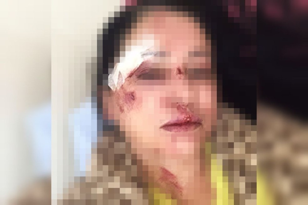 Mulher foi agredida principalmente no rosto em Palmital — Foto: Assiscity/ reprodução