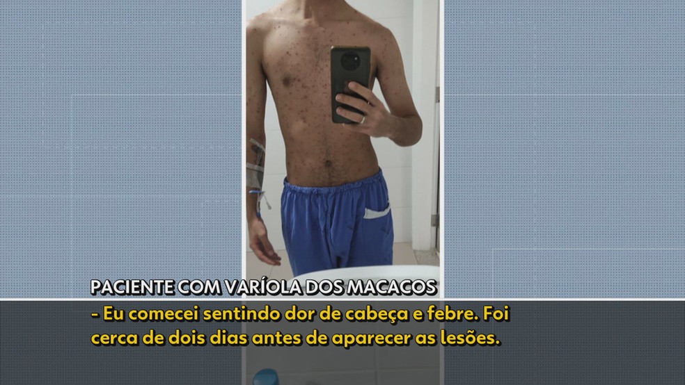 Jovem de SP com varíola dos macacos tem mais de 200 lesões no corpo — Foto: TV Globo