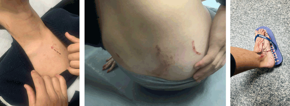 Família agredida por PMs em Santo André mostra fotos dos ferimentos