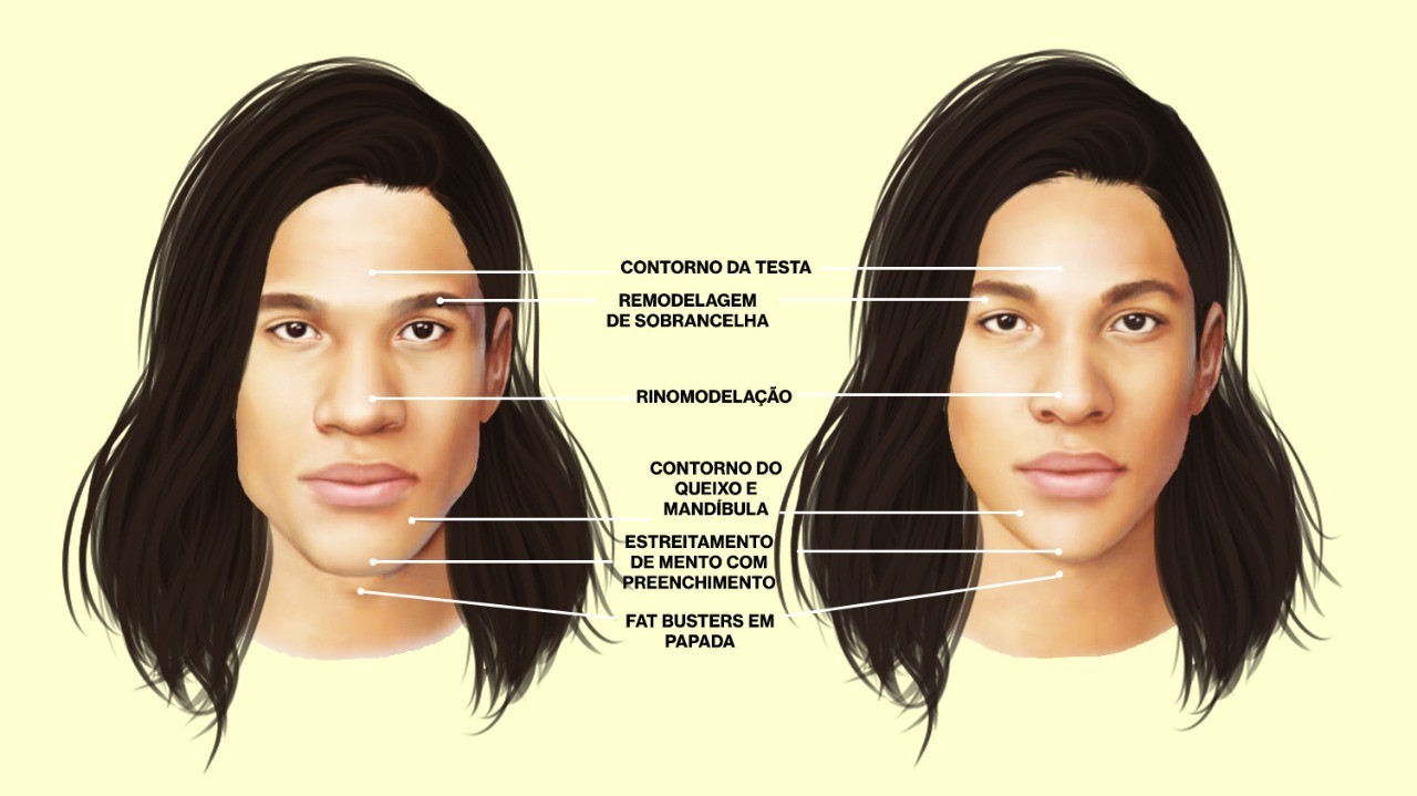 Um exemplo de feminização facial, com contornos do rosto suavizados (Foto: Divulgação)