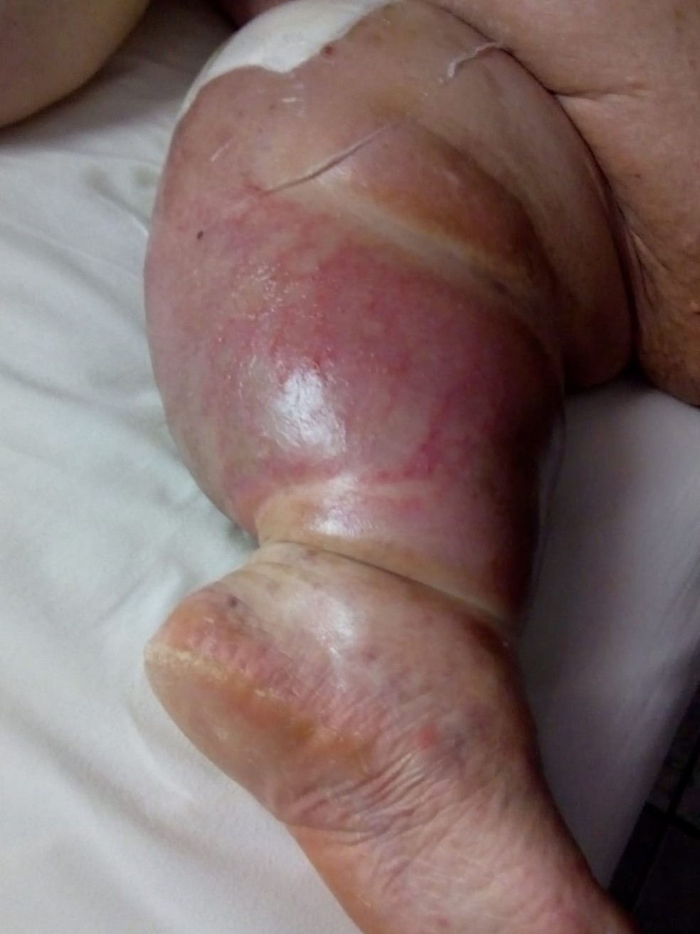 Aposentada disse que adquiriu bactéria quando fazia um exame no Pronto-Socorro de Rio Branco, ano passado — Foto: Arquivo pessoal