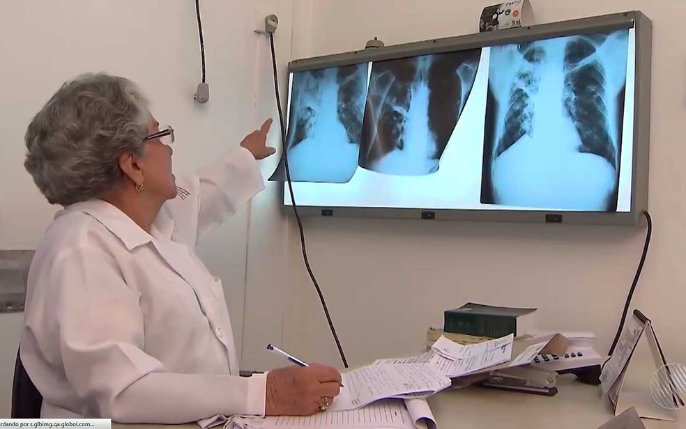 Tuberculose é uma inflamação no pulmão, provocada por uma bactéria — Foto: Imagem/TV Bahia