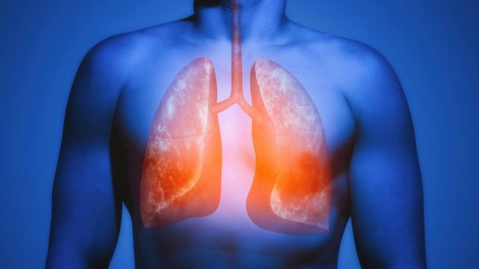 De acordo com os pesquisadores, algumas células pulmonares parecem \'viver em um bunker nuclear\' — Foto: Getty Images/BBC
