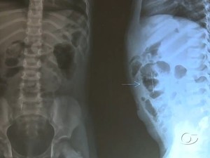 Radiografia mostra agulhas no corpo da menina de 3 anos  (Foto: Reprodução/TV Gazeta)