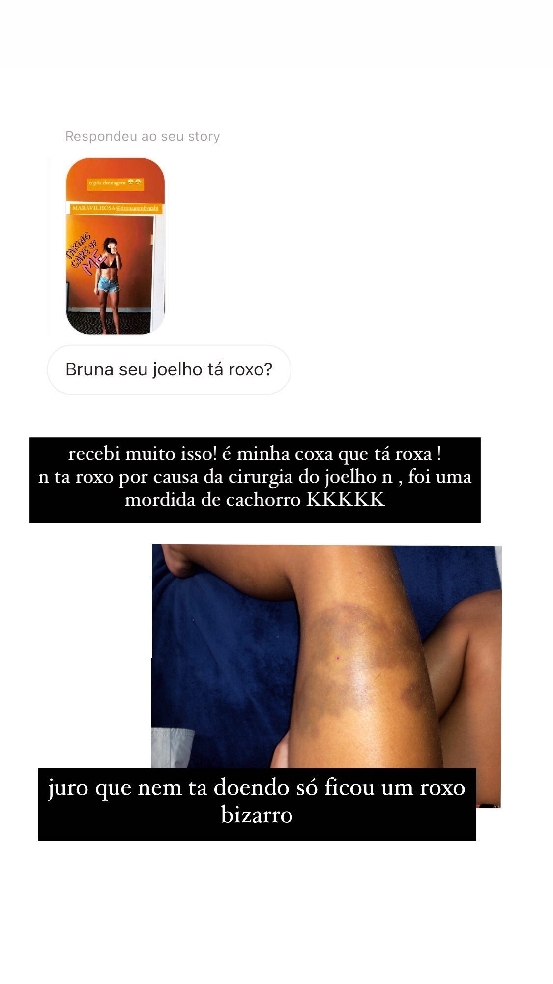 Bruna Griphao mostra hematomas após mordida de cachorro (Foto: Reprodução/Instagram)