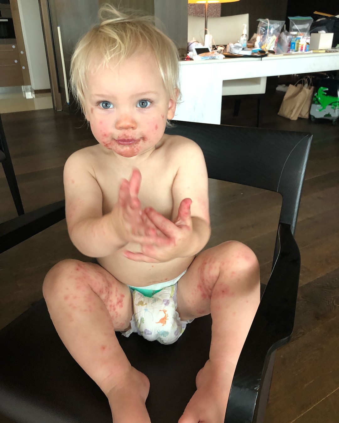 Jameson, filho de Pink e Carey Hart, com doença mão-pé-boca (Foto: Reprodução / Instagram)