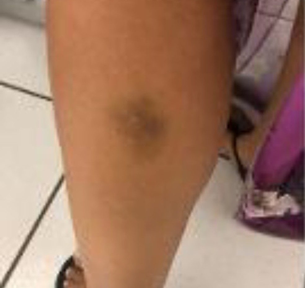 Hematoma na perna da funcionária do motel atingida por uma das balas disparadas pelo coronel da PM — Foto: Arquivo Pessoal