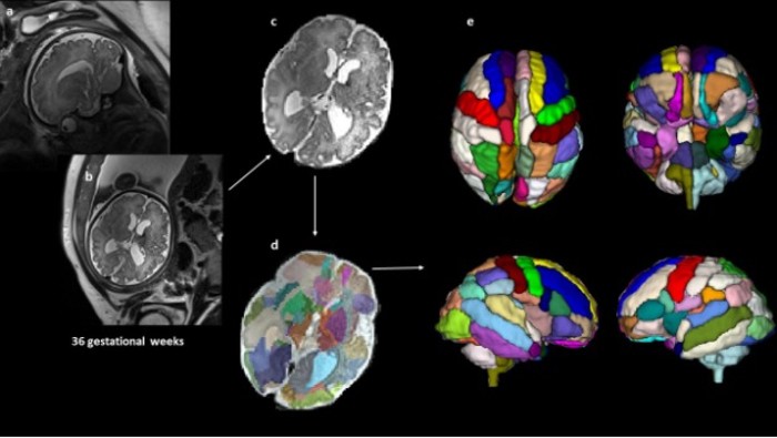 Imagens das ressonâncias de cérebros dos 39 fetos (Foto: Alpen Ortug and Emi Takahashi, Harvard Medical School)