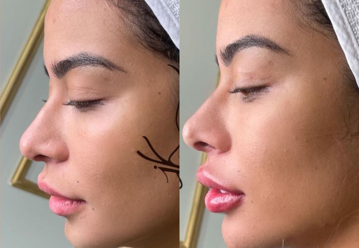 Antes e depois de Rafaella Santos  (Foto: Reprodução/Instagram)