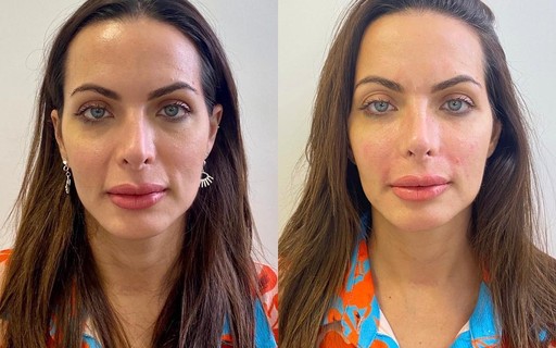 Carla Prata mostra antes e depois de preenchimento facial