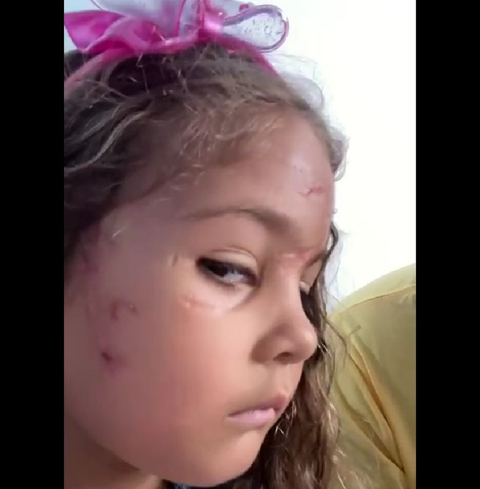 Menina atacada por pitbull em agosto em Itabaiana — Foto: Arquivo pessoal