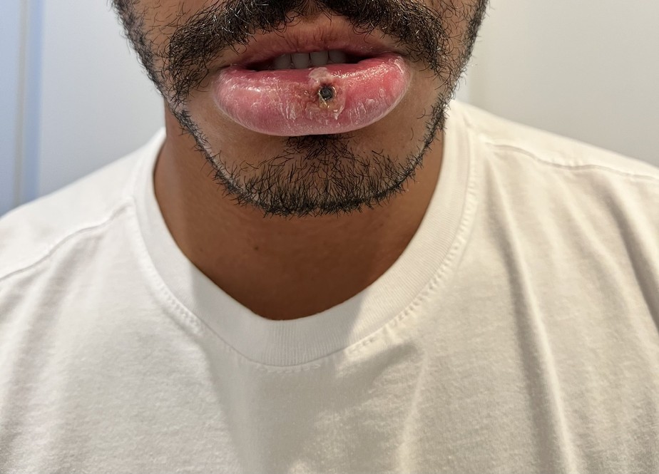 João Pinheiro mostra as lesões causadas pela varíola dos macacos em seu lábio