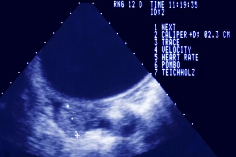 Ecografia mostrando uma gravidez extrauterina (Foto: GETTY IMAGES via BBC)