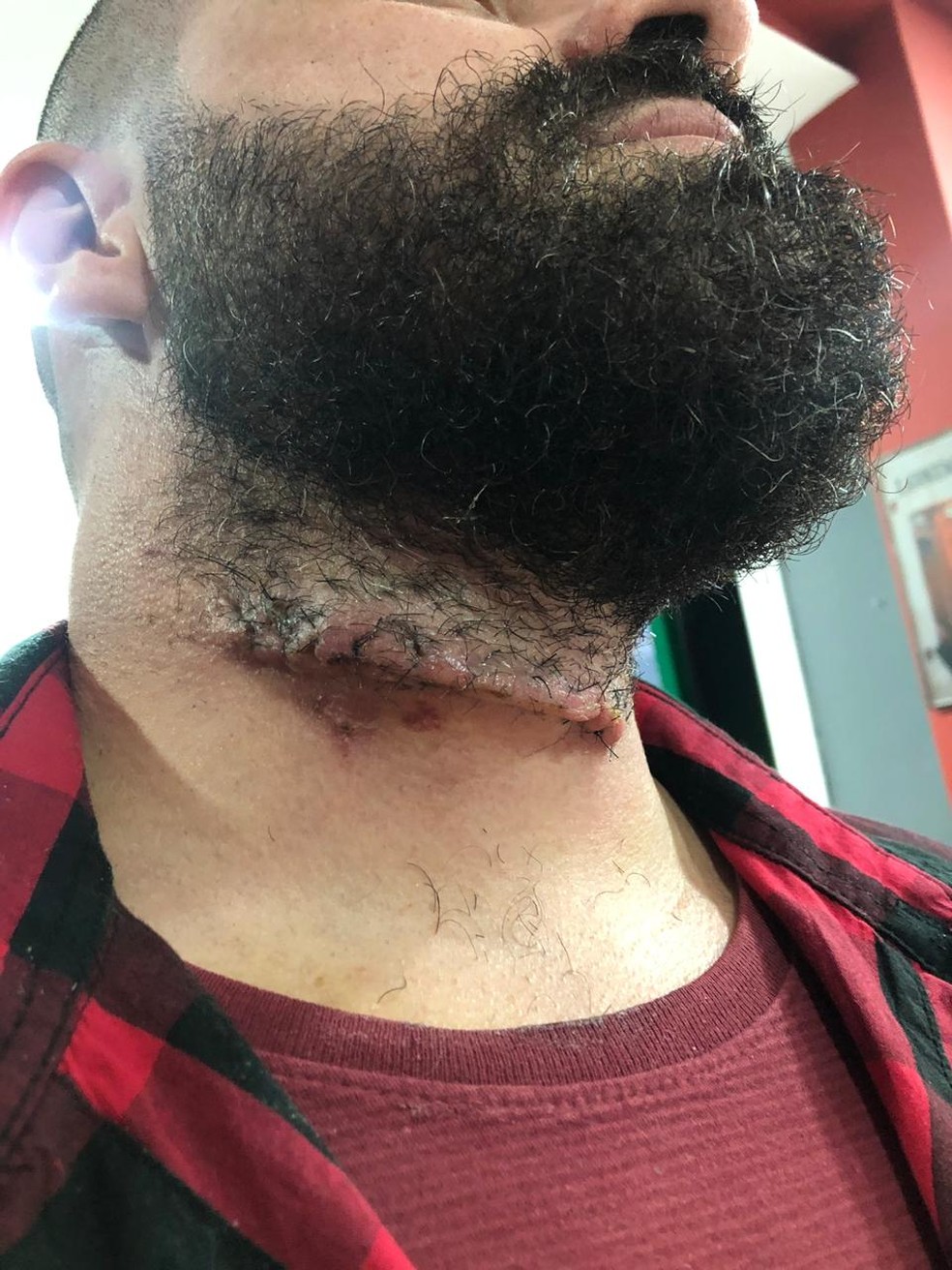 Engenheiro levou 46 pontos após ter pescoço cortado por linha com cerol — Foto: Arquivo pessoal 