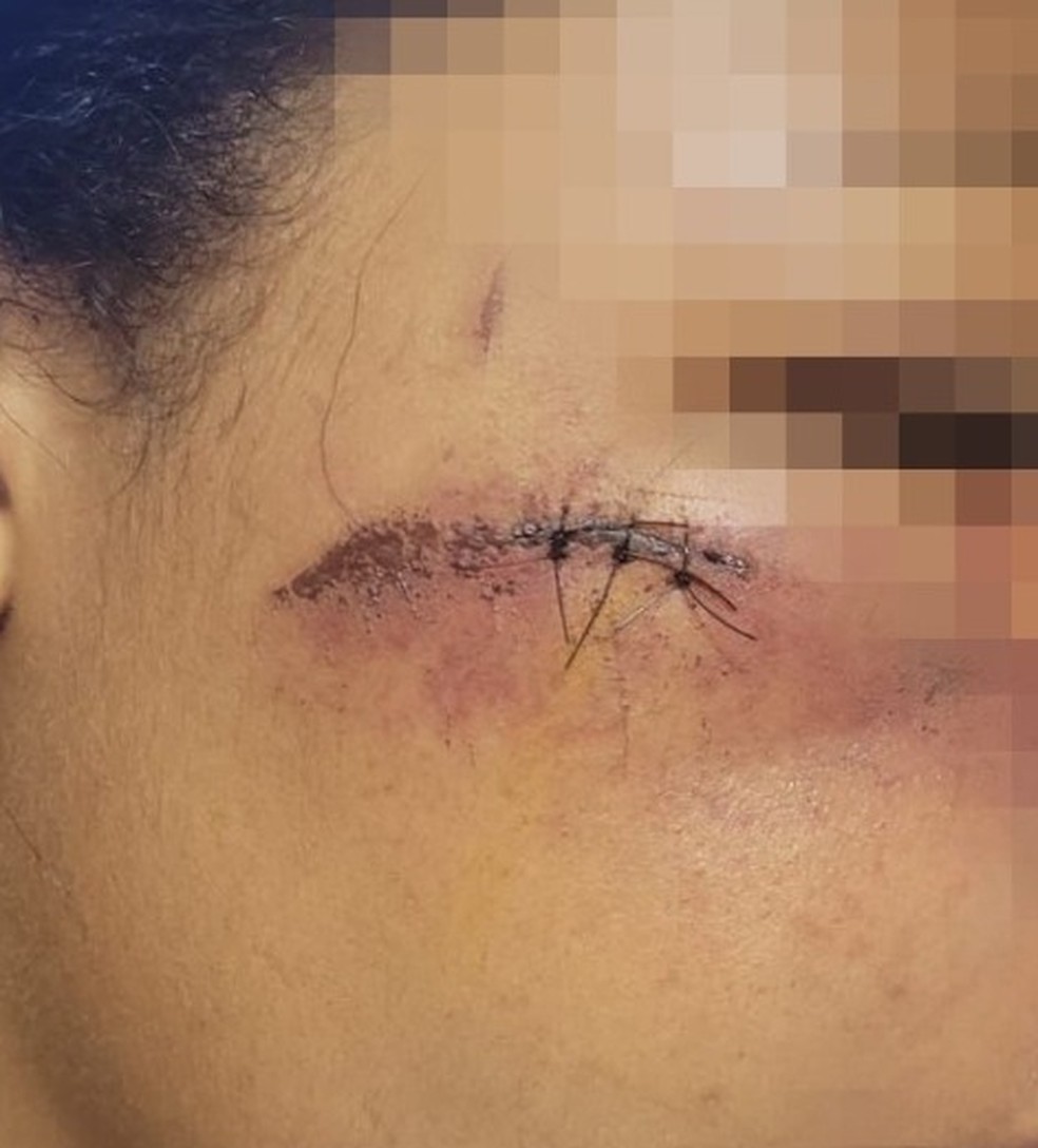Jovem de 18 anos ficou ferida após ser agredida por namorado, no DF — Foto: PCDF/Divulgação