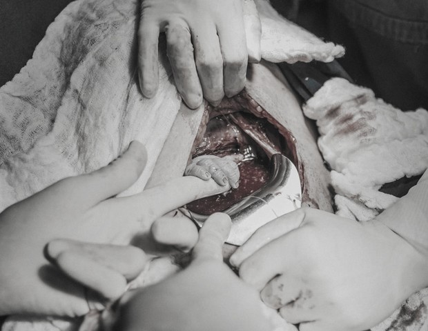 A pequena Luana segurando a mão da obstetra antes mesmo de nascer  (Foto: Bruna Costa)