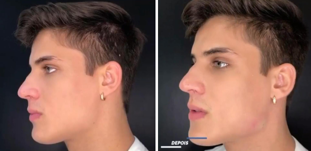Tiago Ramos faz harmonização facial (Foto: Reprodução / Instagram)