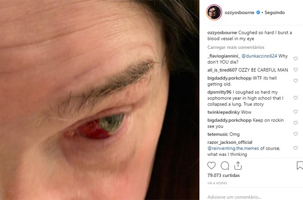 Ozzy Osbourne estoura veia no olho após forte tosse (Foto: Reprodução/Instagram)