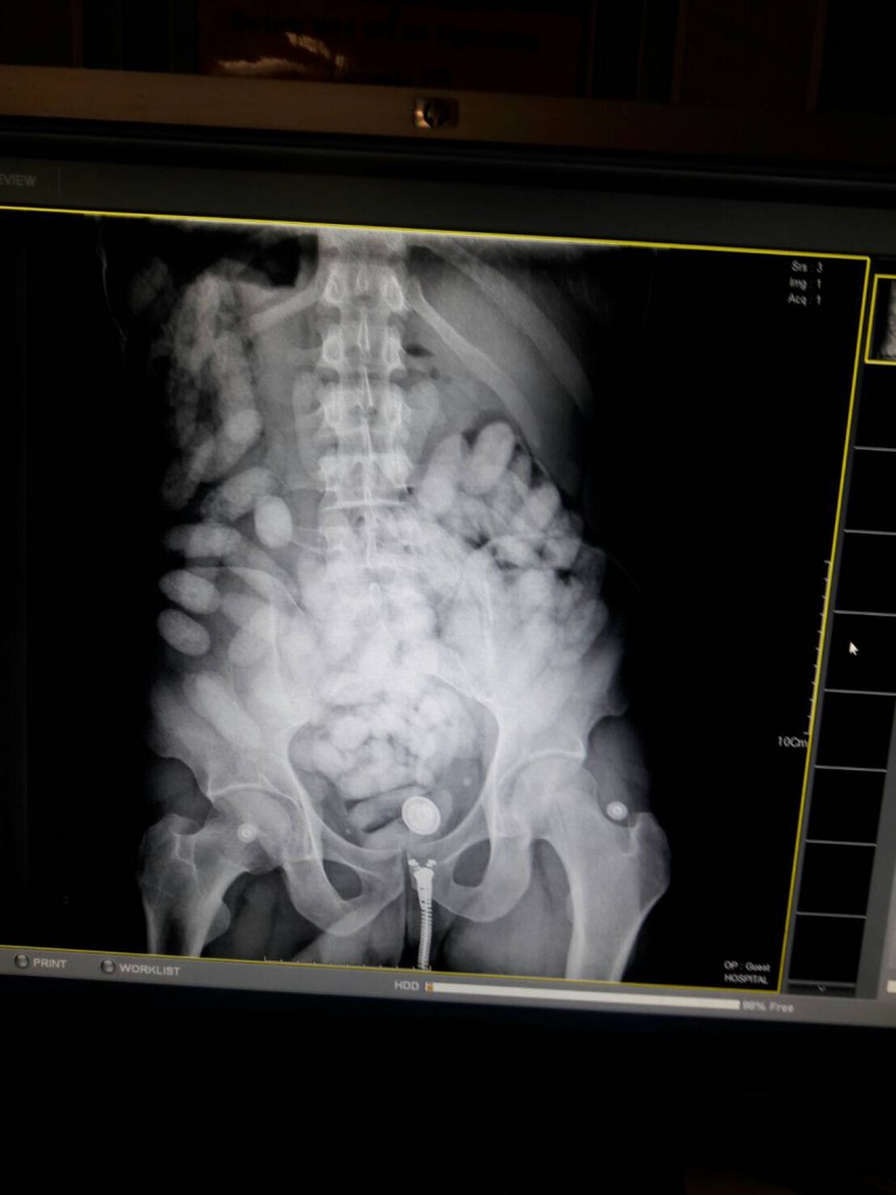 Imagem dos raios x do corpo do brasileiro detido na Tailândia que mostra as cápsulas usadas para transportar a droga  (Foto: Reprodução/Thai Drug Police)