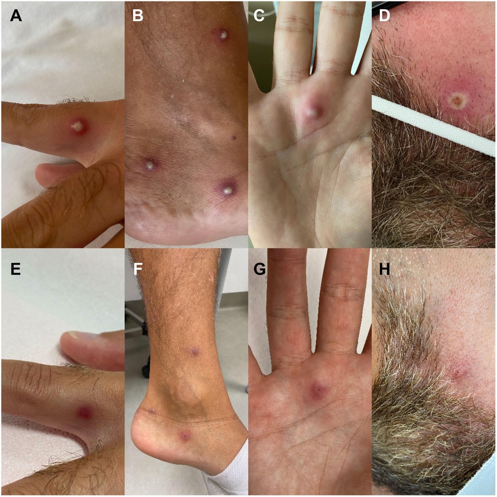 Imagens mostram as lesões cutâneas da monkeypox em paciente na Itália — Foto: Reprodução/Journal of Infection