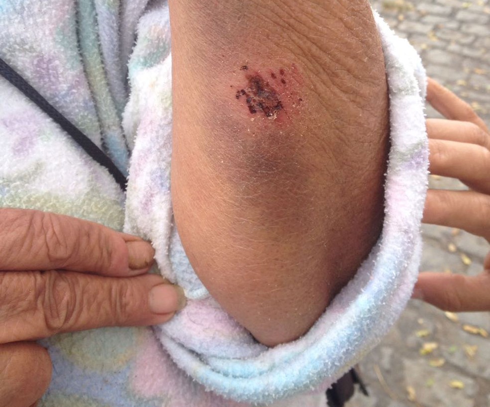 Maria também sofreu ferimento no braço após ser atingida por pedra (Foto: Arquivo Pessoal)