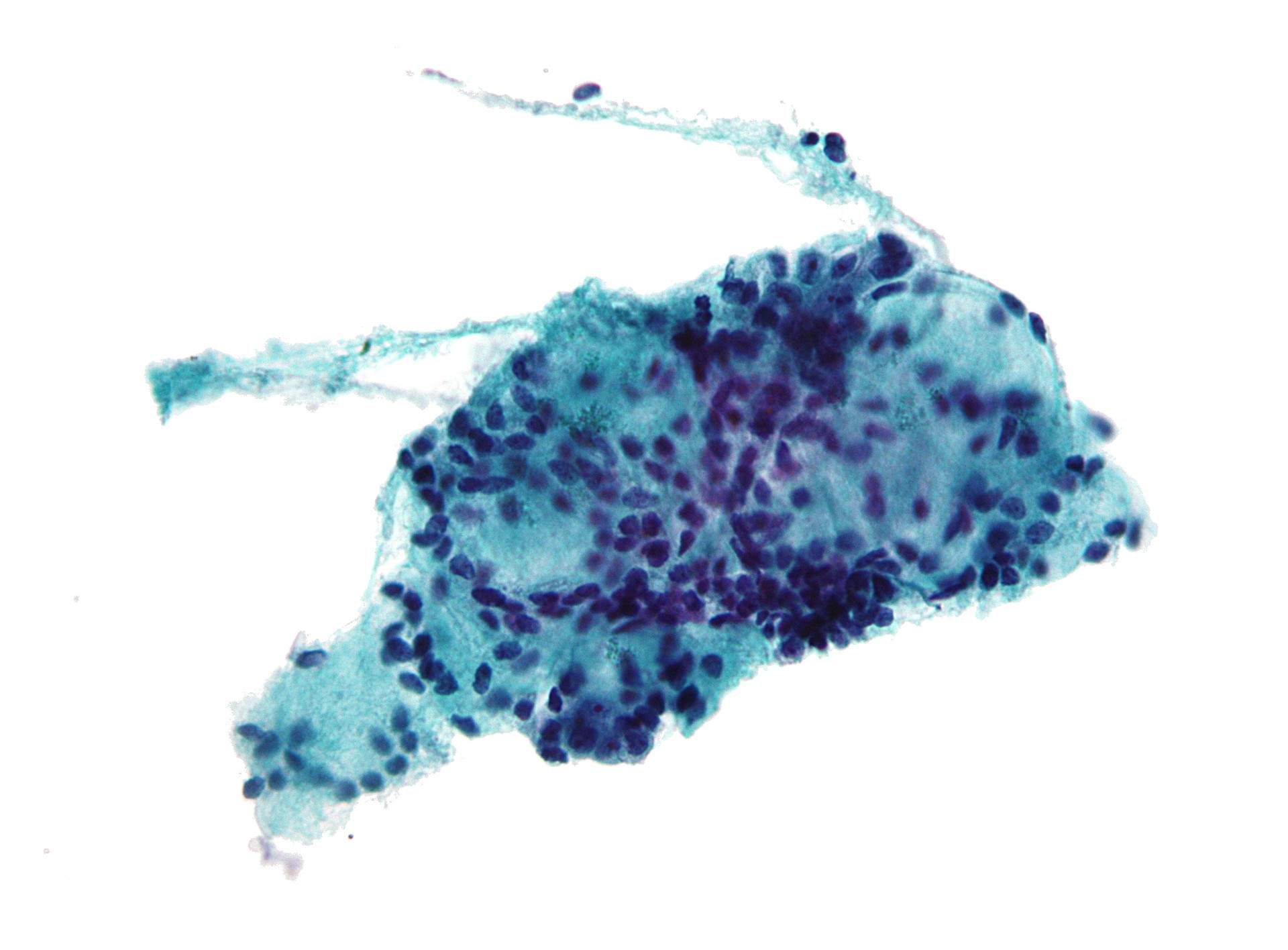 Carcinoma adenoide cístico do pâncreas (Foto: wikimedia commons)