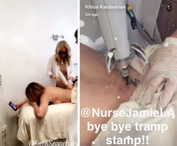 O processo de remoção da tatuagem de Khloé Kardashian (Foto: Snapchat)