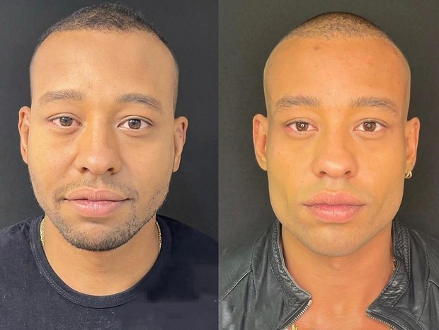 Harmonização facial em homens: veja o antes e depois de 10 famosos - Quem