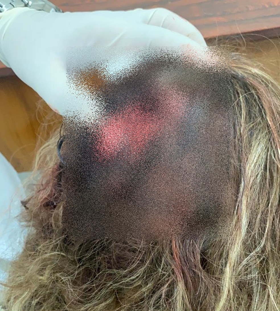 Mulher sofreu corte na cabeça com agressões em Urupês — Foto: Arquivo Pessoal