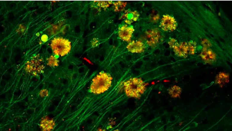 Imagem de baixa resolução, vista por microscopia fluorescente, mostra formações semelhantes a flores de vacúolos autofágicos em neurônios de camundongos com doença de Alzheimer (Foto: Nature Neuroscience/Springer-Nature Publishing)