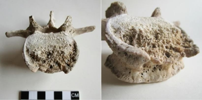 Fotografia da quarta vértebra lombar acometida por espondilodiscite tuberculosa de um indivíduo de Pompeia (Foto: Gabriele Scorrano et.al )