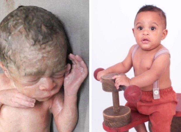 Antes e depois de Gael, que nasceu com 33 semanas (Foto: Arquivo pessoal)