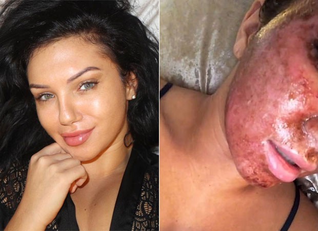 Alexandra Cane: antes e depois do procedimento estético  (Foto: Reprodução)