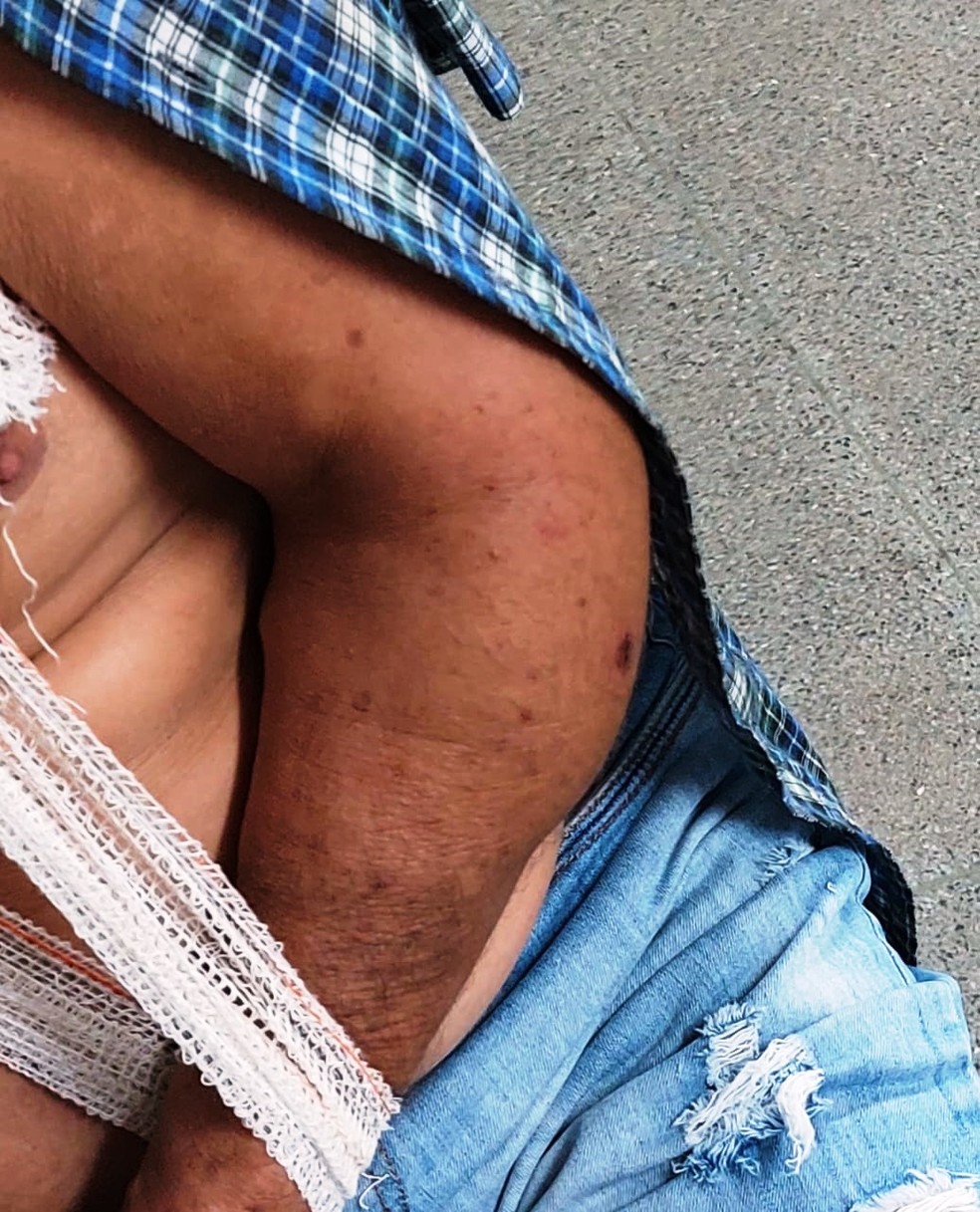 Idoso ficou com região do cotovelo inchada após agressão no trânsito  — Foto: Arquivo Pessoal