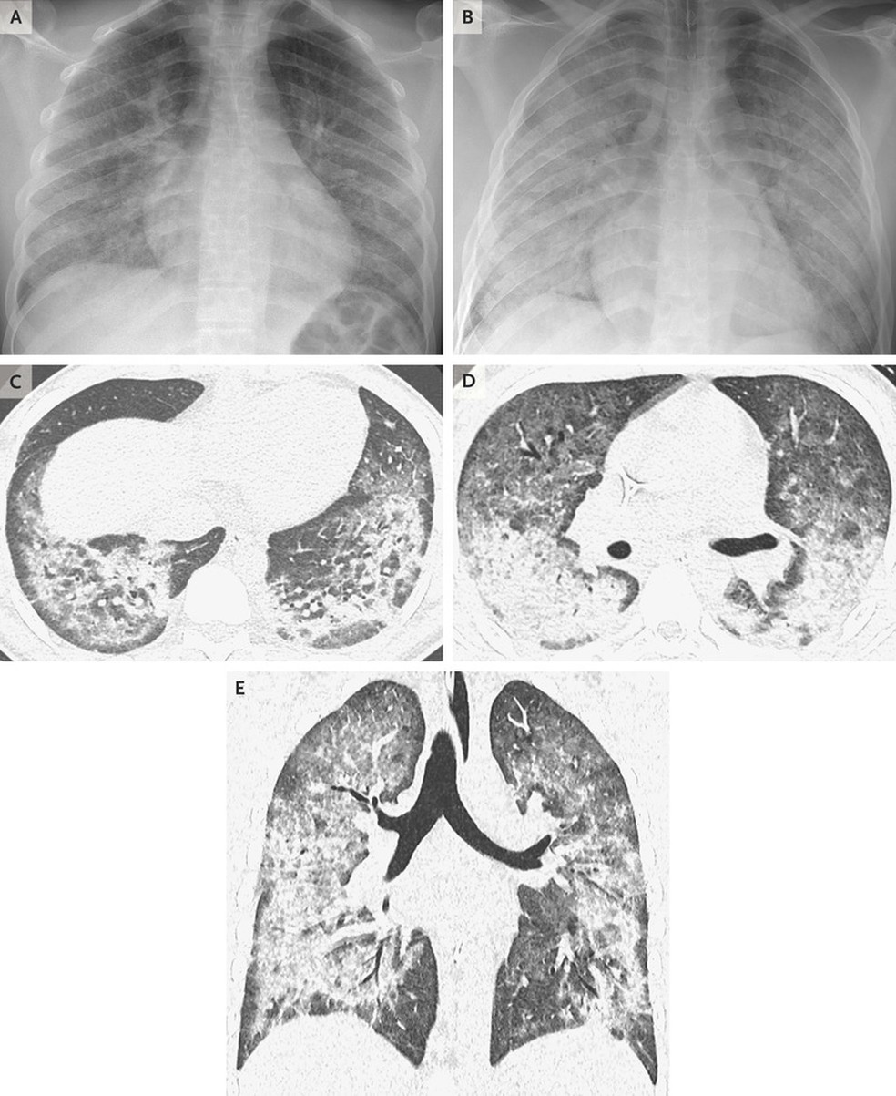 Radiografias e tomografias de alta resolução de um paciente de 17 anos mostram uma doença pulmonar difusa — Foto: New England Journal of Medicine