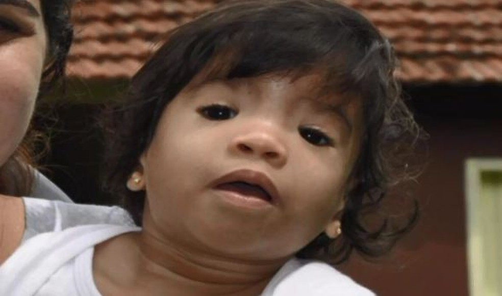 Ana foi adotada aos nove meses de vida e faz tratamento em Rio Branco  (Foto: Reprodução/Rede Amazônica Acre)