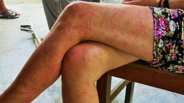 Rachel Bradley sofreu arranhões nas pernas durante período em que ficou perdida no meio da selva (Foto: PA/NINTH WAVE GLOBAL)