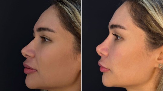 Ex-BBB Jake Leal faz procedimentos estéticos no rosto e no corpo; veja antes e depois
