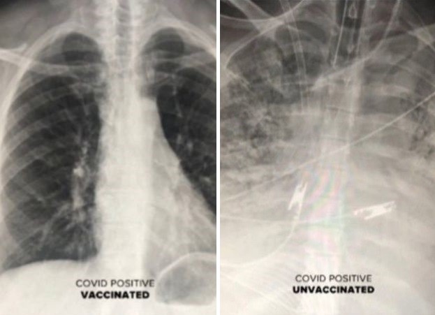 À esquerda, pulmões de paciente não vacinado quase que completamente comprometido, com muitas áreas em branco. À direita, pulmões de paciente vacinado com muitas áreas escuras, o que significa que há muito ar circulando (Foto: Reprodução/Mirror)