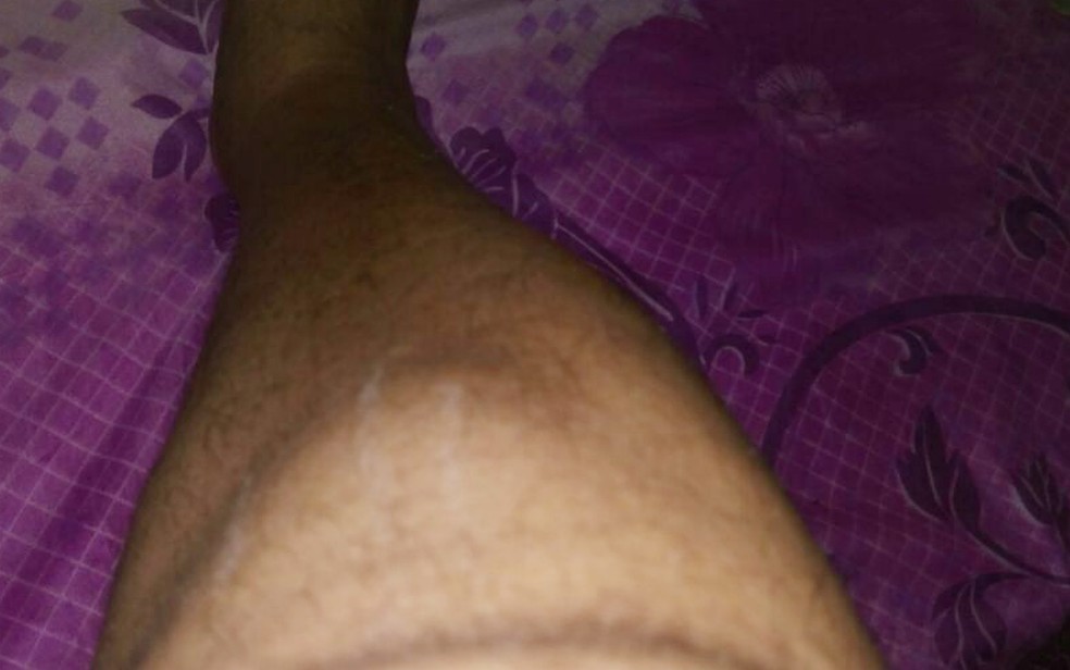 Agente da Fundação Casa sofreu hematomas nas pernas após ser agredido com chutes por interno  (Foto: Divulgação)
