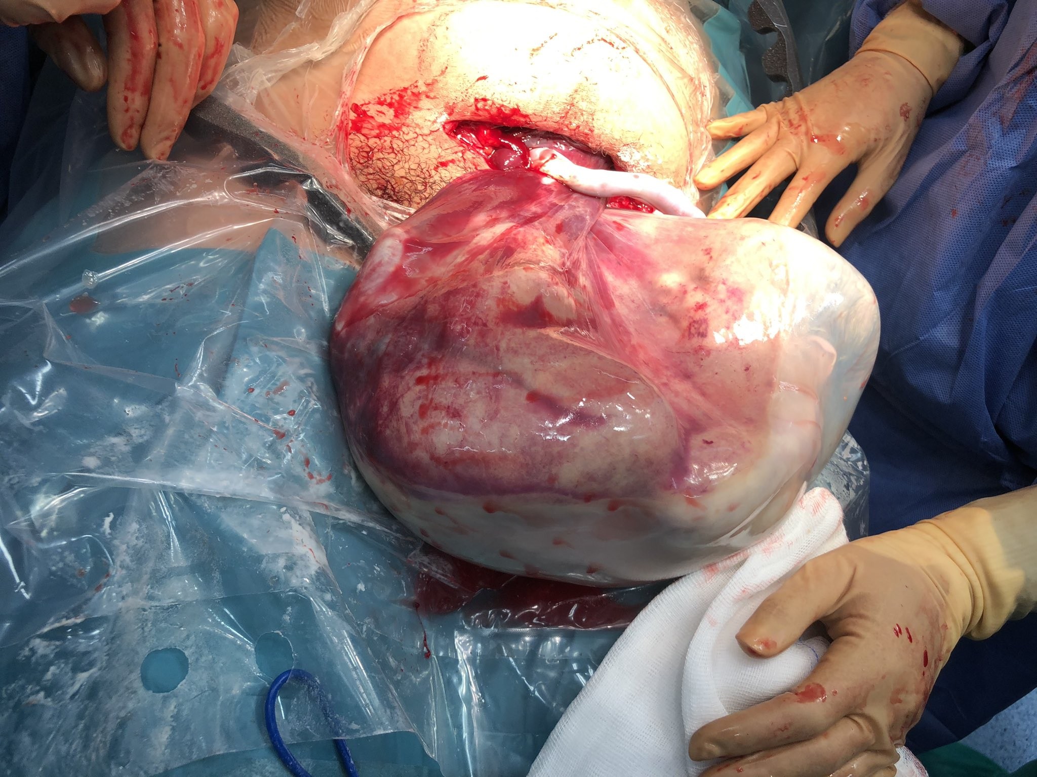 Médica se emociona em parto de gêmeos envolvidos por bolsa amniótica (Foto: reprodução/twitter)