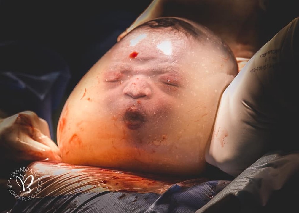 28 de janeiro - O bebê Noah faz biquinho ao nascer empelicado, sem estourar a bolsa amniótica, em um hospital de Vila Velha (ES). 'Ganhei um presente embalado', contou a mãe ao G1 após a repercussão das fotos — Foto: Janaína Brasil/Divulgação 