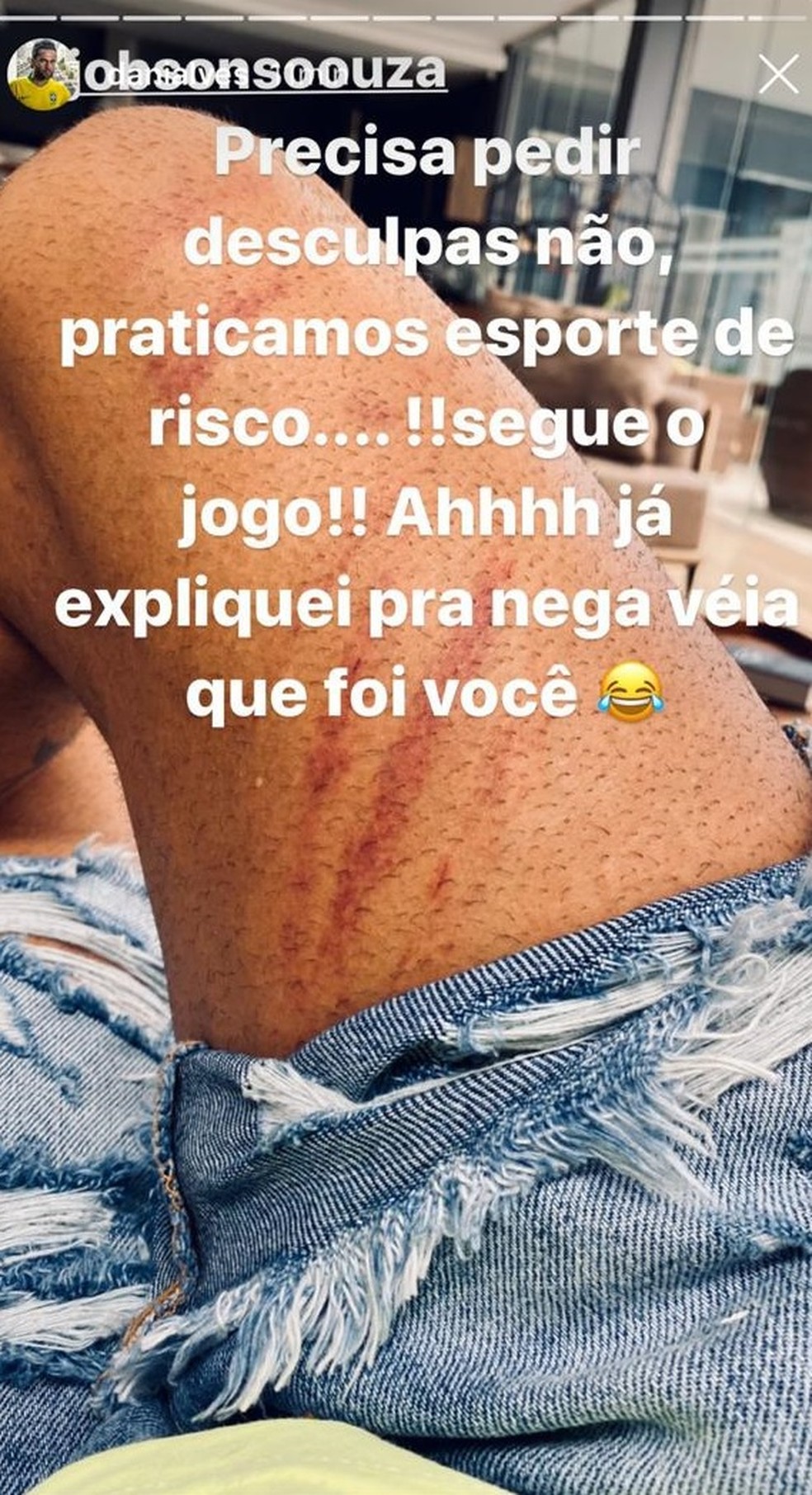 Daniel Alves diz que Jobson não precisa pedir desculpas por pisão na coxa e mostra marcas — Foto: Reprodução / instagram